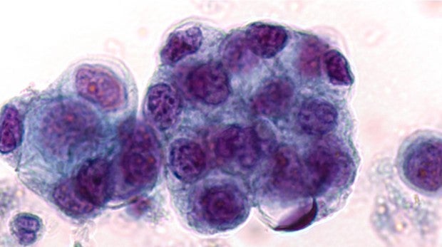 Dos fármacos combinados, eficaces contra el cáncer de páncreas