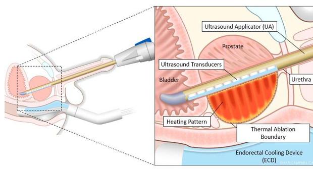 TULSA, la técnica de ultrasonidos que destruye el cáncer de próstata