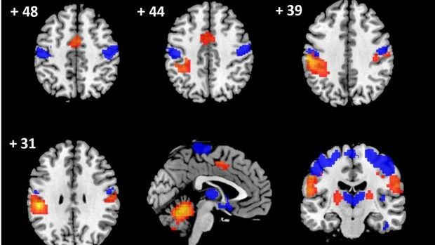 La IA y las técnicas de imagen detectan daño cerebral en personas con hernias cervicales
