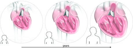 La válvula cardíaca que crece al mismo tiempo que el niño