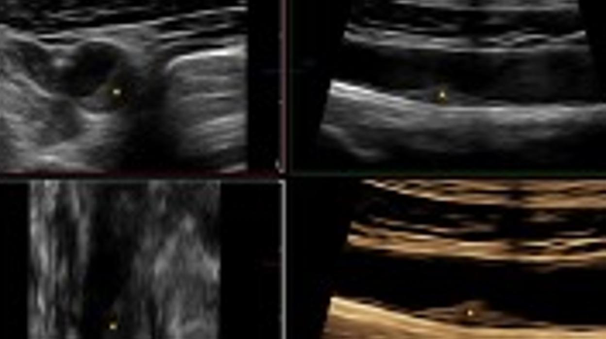 En la imagen se muestra con un asterisco la presencia de una placa de aterosclerosis avanzada en la carótida común detectada por la técnica de ecografía 3D que no llega a ocasionar una obstrucción significativa de la luz del vaso (es &lt;50%).