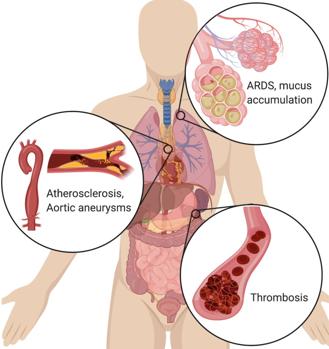 Neutrófilos, las células inmunes hiperactivas que causan muertes por COVID-19