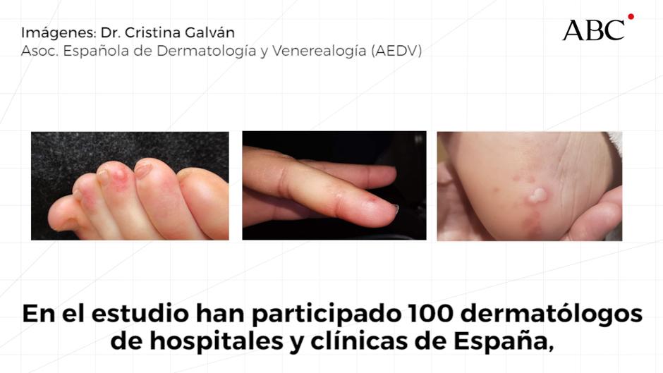 Las manifestaciones de la Covid-19 en la piel