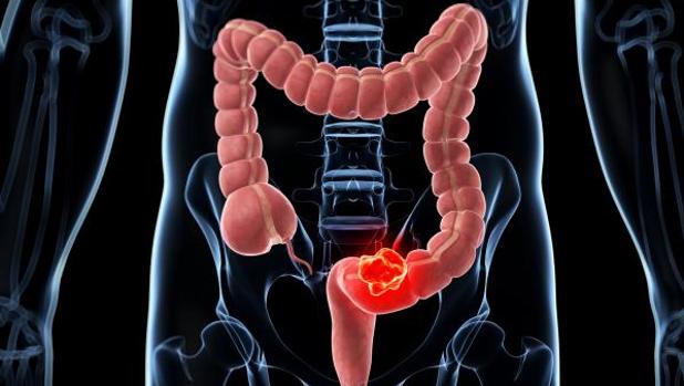 La dieta que reduce a la mitad el riesgo de cáncer de colon