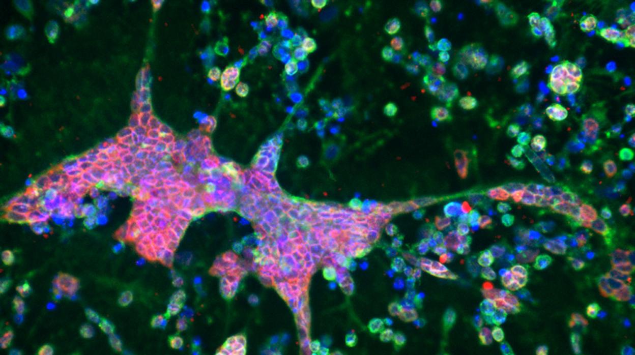 Inmunotinción fluorescente en la que el rojo muestra fibrillas beta amiloides, el verde indica células infectadas con VSH-1 y el azul indica células muertas teñidas con DAPI.