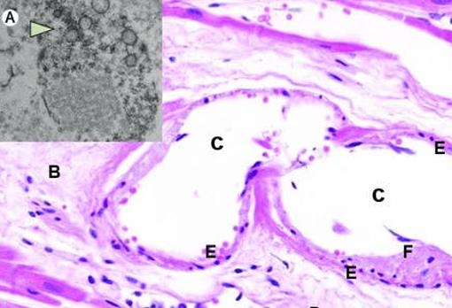 Imágenes de microscopía electrónica de transmisión (A), y microscopía óptica, tinción H&E, de corte histológico de músculo cardíaco (B-H), en paciente con Covid-19 fallecido por infarto de miocardio. El corte procede del músculo cardíaco conservado, no afectado por el infarto. A: detalle de porción citoplásmica de célula endotelial cargada de virus. Los agregados de partículas virales (flecha), se muestran como círculos densos con centro claro. B: estroma conectivo laxo edematoso de músculo cardíaco, con vaso sanguíneo dilatado (C). D: células musculares cardíacas conservadas (cardiomiocitos). E: células endoteliales reactivas que tapizan el vaso, con restos de fibrina adheridos (F), y algunos linfocitos dispersos bajo el endotelio (G). H: hematíes dentro de la luz del vaso. El grado de endotelitis es mínimo, casi imperceptible en microscopía óptica