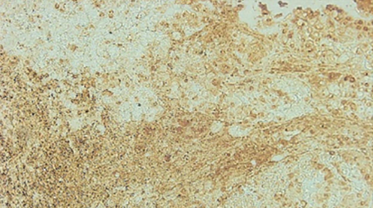 Se puede observar un gran número de microglia M2 (marrón) en un tumor cerebral metastásico de un paciente con cáncer de pulmón que continuó fumando.