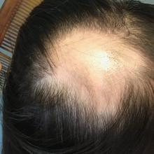 Alopecia areata