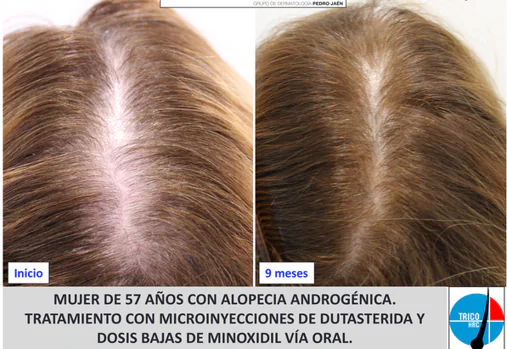 Discriminar capacidad Alargar Estos son los mejores tratamientos para la alopecia en las mujeres