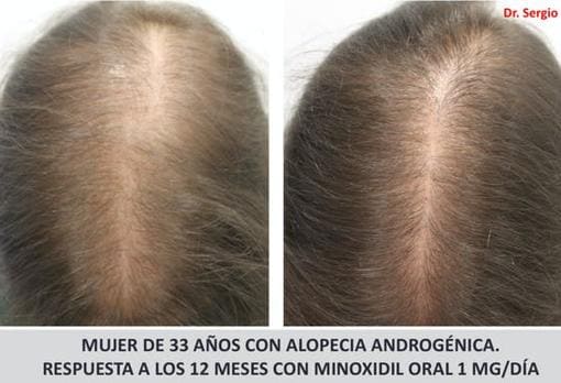 Estos son los mejores tratamientos la alopecia en las