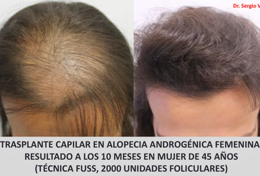 Estos son los mejores tratamientos para la alopecia en las mujeres