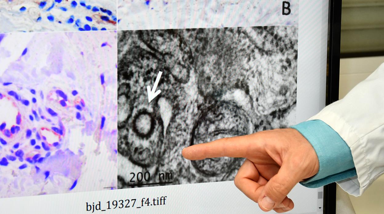 Investigadores del Niño Jesús han conseguido visibilizar el coronavirus en lesiones de la piel