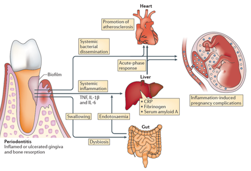 Periodontitis y enfermedades sistémicas. Esta figura resume cómo, en periodontitis, las bacterias de la placa dental (biofilm), sus enzimas y otros productos bacterianos, y moléculas proinflamatorias producidas por células humanas en las encías, pueden llegar a otras partes del cuerpo y causar complicaciones.