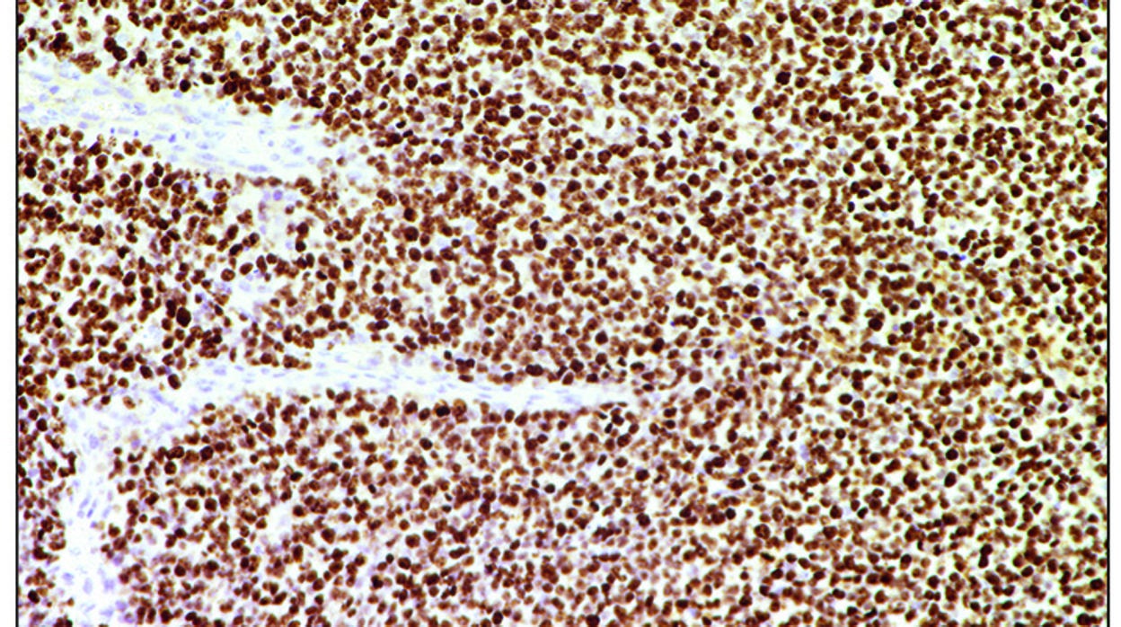 Reprograman por vez primera CRISPR para eliminar genes de fusión en células tumorales