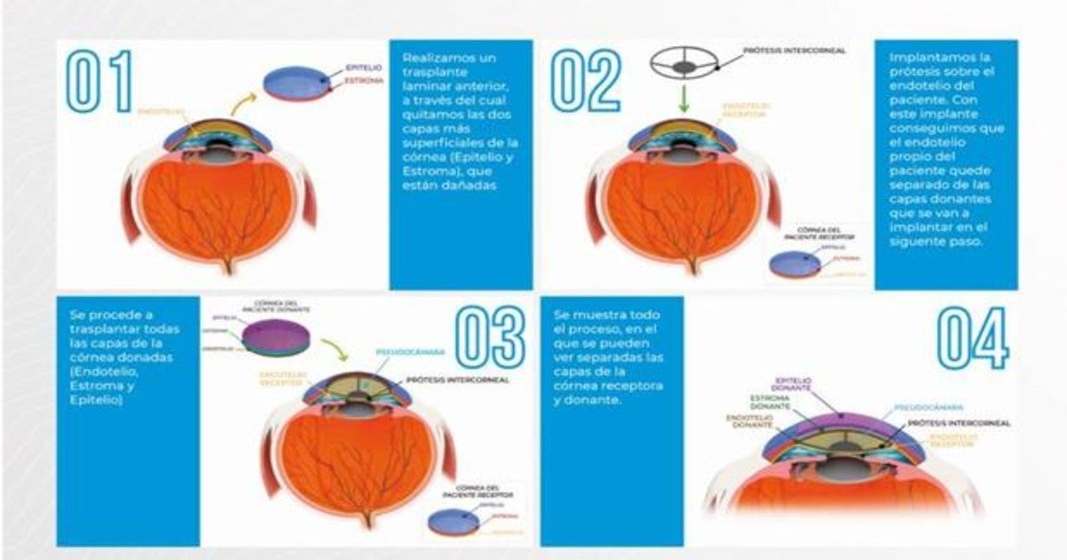 Prótesis corneal