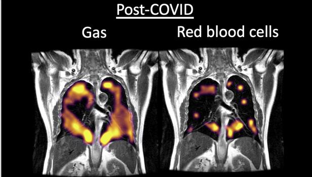 Esto es lo que provoca la Covid-19 en los pulmones: daño casi irreversible