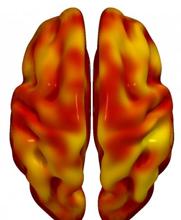 Reconstrucciones 3D de regiones cerebrales superior (izquierda) e inferior (derecha), que muestran regiones con menor metabolismo asociadas con la presencia de placas ateroscleróticas en las arterias carótidas. El código de color indica la magnitud de la observación (amarillo, asociación fuerte; rojo, asociación más baja). El gris indica áreas que no muestran asociación con la presencia de placa carotídea.