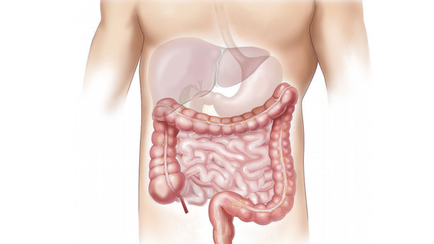 Estos son los síntomas más habituales del cáncer de colon