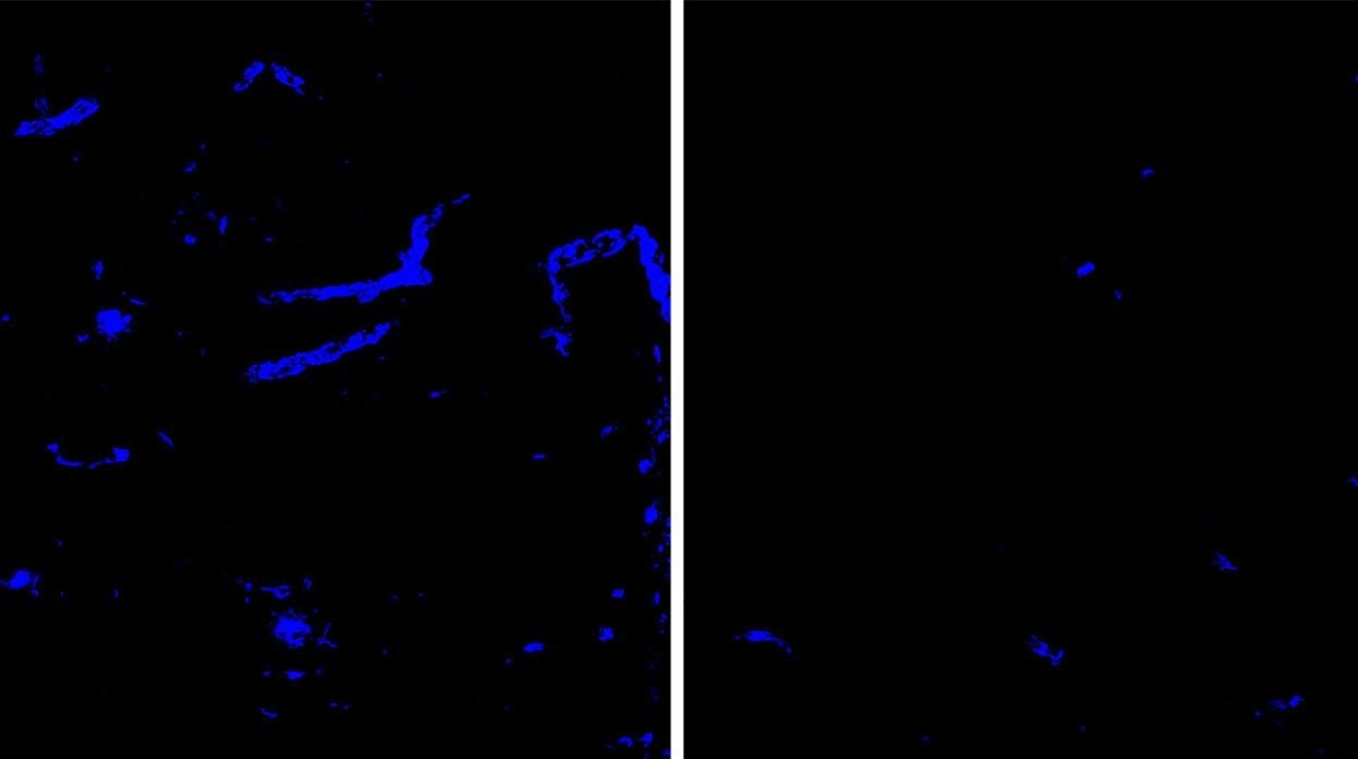 Los depósitos de amiloide (azul) en el tejido cerebral y vasos sanguíneo