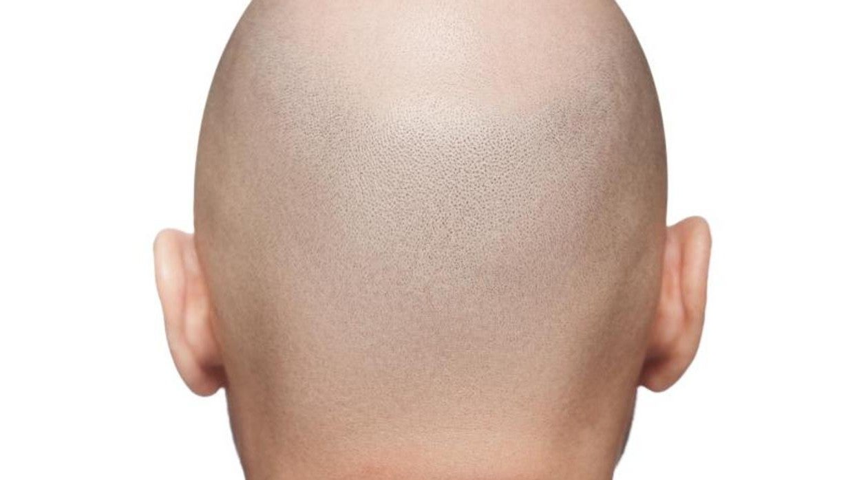 Existen actualmente hasta 150 tipos de alopecia o pérdidas de pelo que requieren de diferentes formas de tratamiento.