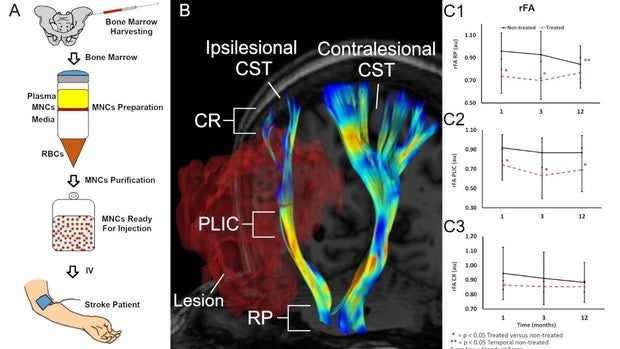 Células de médula ósea regeneran el cerebro después de un ictus