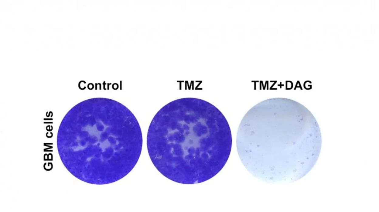 La combinación de temozolomida (TMZ) con dianhydrogalactitol (DAG; placa de cultivo derecha) es capaz de eliminar células de glioblastoma resistentes a la terapia convencional con temozolomida (TMZ; centro)