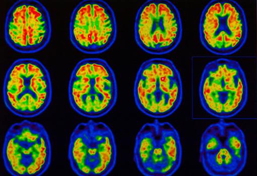 Imágenes PET de cerebro con detección de amiloide por enfermedad de Alzheimer. Las zonas en rojo muestran depósito de amiloide, es una de las proteínas que caracterizan a la enfermedad de Alzheimer.