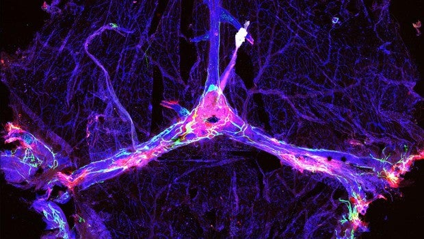 La aprobación de aducanumab, la gran oportunidad para el alzhéimer en el mundo real