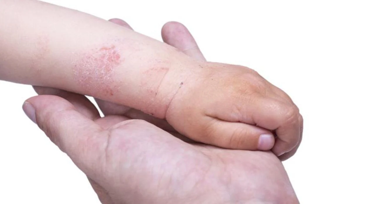 Erupción en la piel por la dermatitis atópica