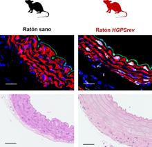 Aortas de un ratón sano y un ratón HGPSrev enfermo de progeria. Como en los pacientes afectados de HGPS, la aorta HGPSrev muestra expresión de progerina (núcleos blancos), pérdida de las células de musculo liso vascular (núcleos morados), y fibrosis vascular prominente (señal verde).