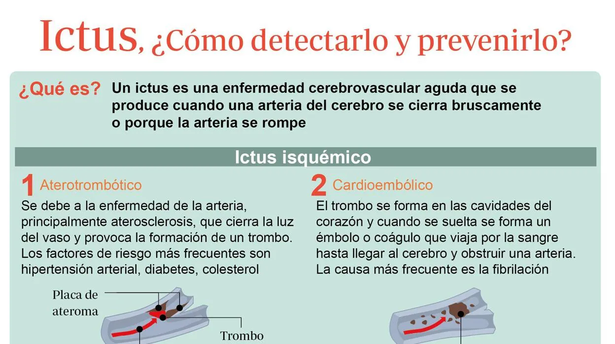 Ictus ¿cómo Detectarlo Y Prevenirlo