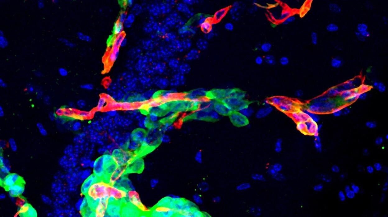 Células metastásicas en el cerebro (en verde) rodeadas por astrocitos reactivos (en blanco); algunos con STAT3 activado (núcleo en rojo). Los astrocitos reactivos con STAT3 activo ayudan a las células tumorales a desarrollarse en el cerebro, modificando la inmunidad local