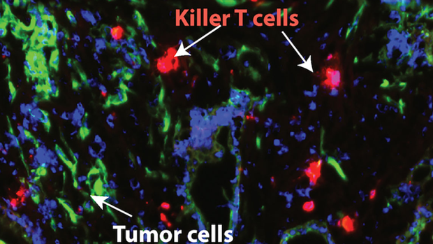 Un nuevo tratamiento hace susceptible a la inmunoterapia al cáncer de páncreas