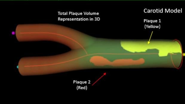 Ecografía 3D matrix, nueva herramienta para prevenir el daño del corazón en personas sanas