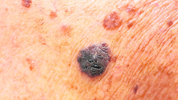 Un lunar sospechoso de ser melanoma