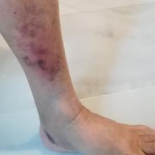 Hematomas en la pierna