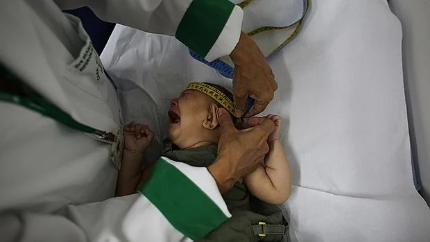 Un bebé con microcefalia en un hospital de Brasil