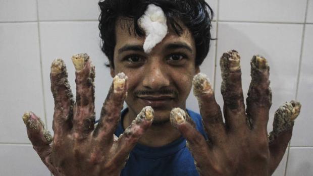 Abul Bajandar, conocido como el «hombre árbol» de Bangladesh, posa con sus nuevas manos