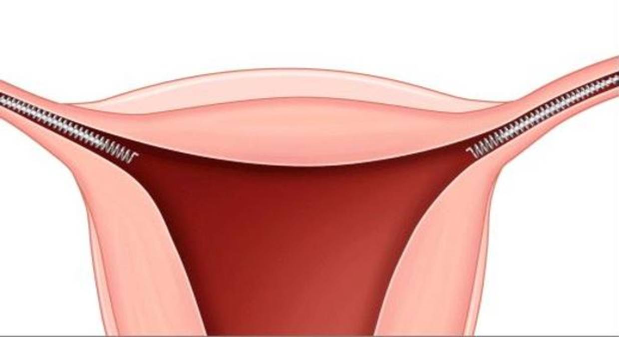 El essure se usa como microinserto de oclusión de lastrompas de Falopio