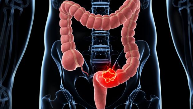 Comer más proteínas y menos verduras protege (a veces) del cáncer de colon