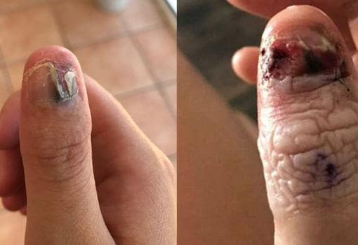 La uña de la joven antes de ser amputado el dedo