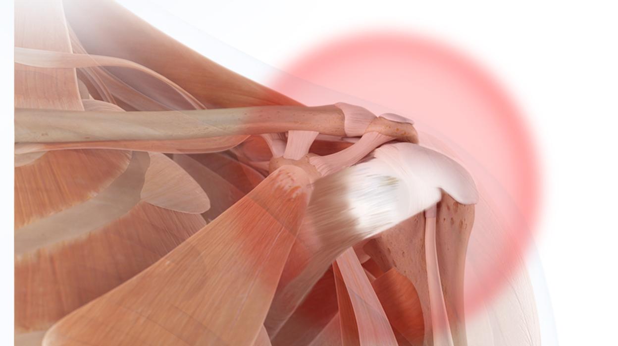 La cirugía más común del hombro no es eficaz