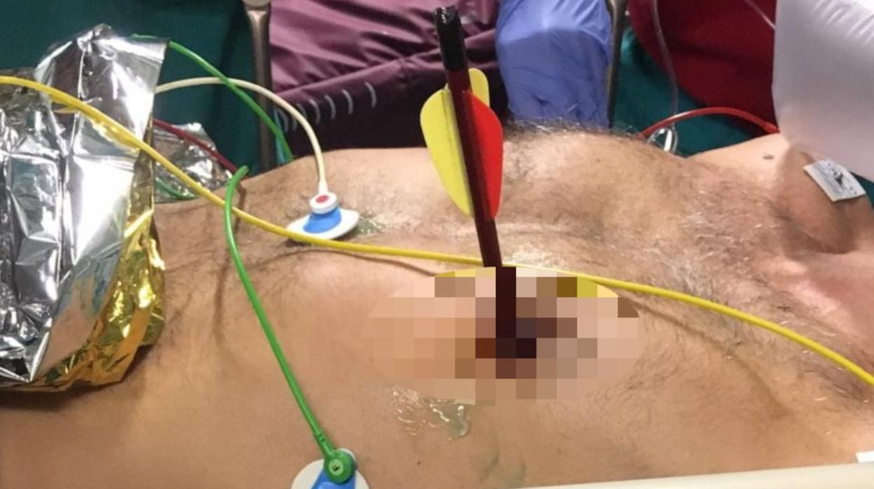 Un hombre de 47 años fue trasladado al hospital con una flecha perforando su pecho