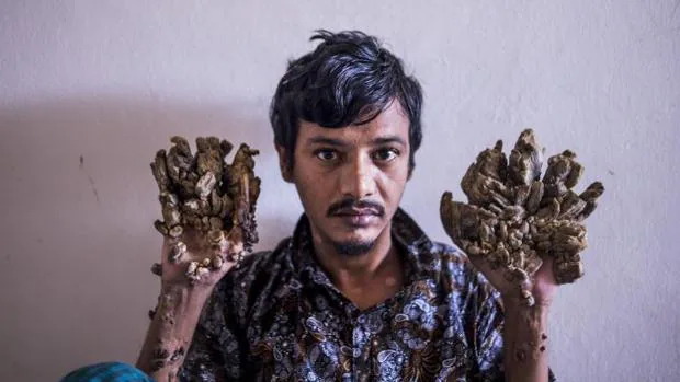 El «hombre árbol» de Bangladés quiere que le amputen las manos para aliviar su dolor