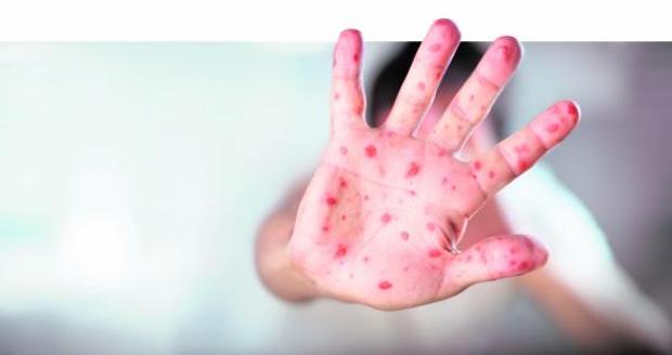 La OMS publica nuevas recomendaciones para evitar el contagio del sarampión