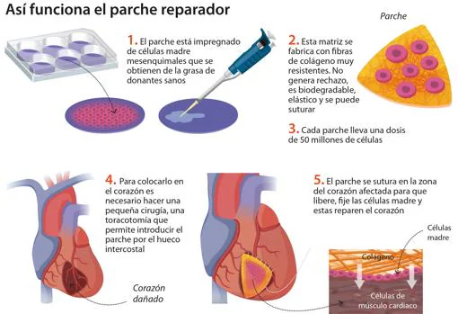 La «tirita» española con células madre que repara el corazón