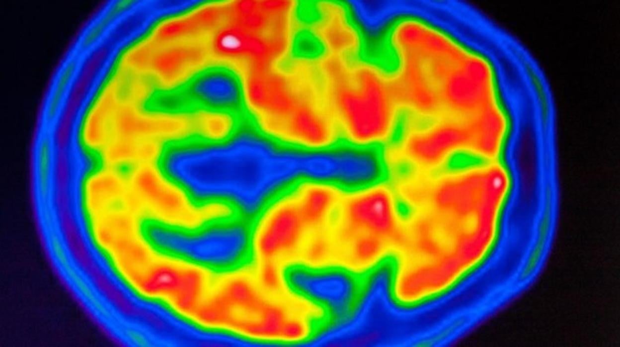 Imágenes PET de cerebro con detección de amiloide por enfermedad de Alzheimer