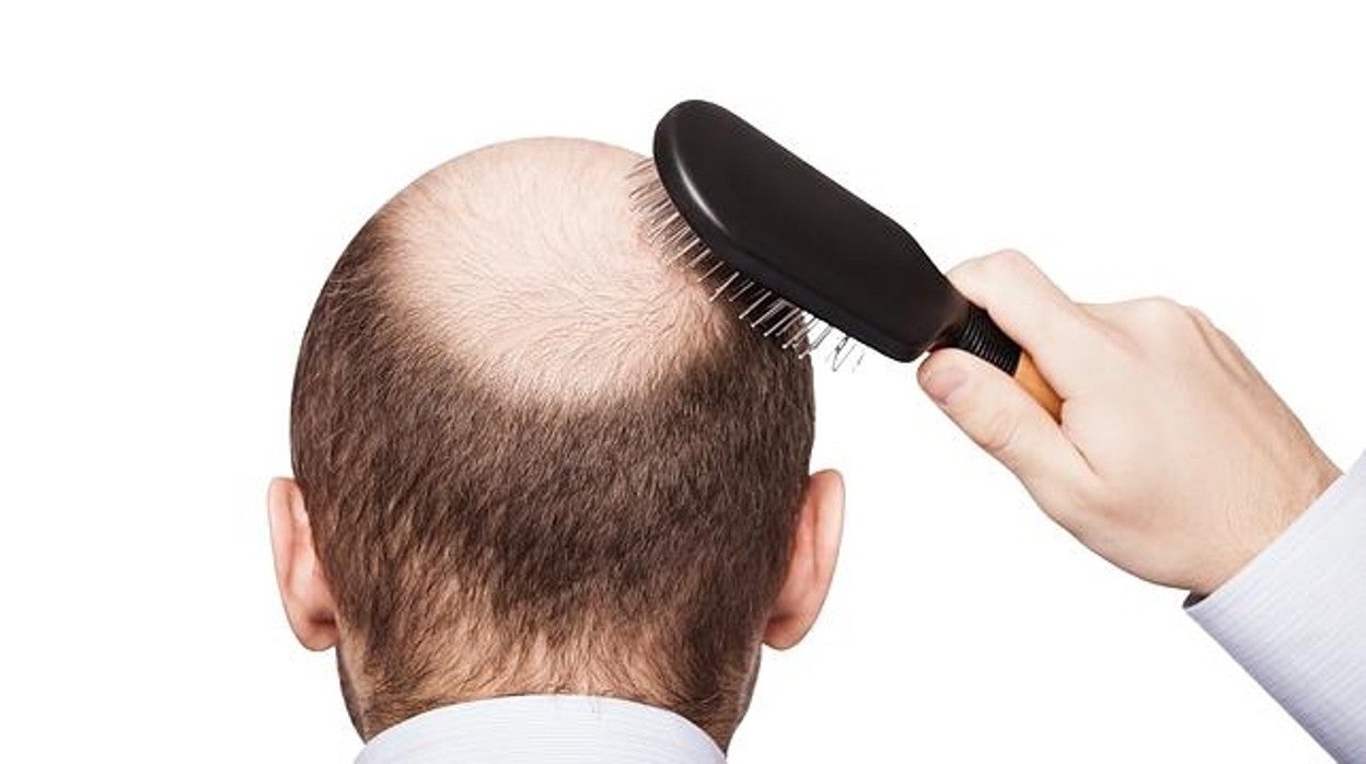 Alopecia masculina