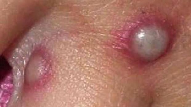 El Centro Europeo para la Prevención y el Control de las Enfermedades aconseja vacunar a los contactos cercanos de los casos de viruela del mono