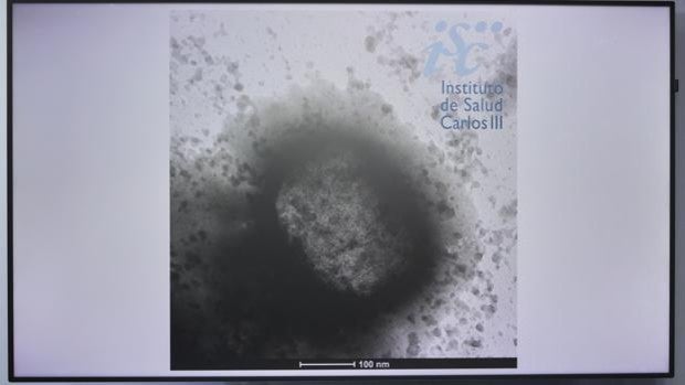 Madrid detecta la primera mujer contagiada por la viruela del mono